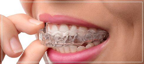 closeup of a person inserting clear aligners onto their teeth